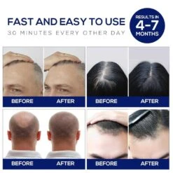 Advanced Laser Hair Growth Cap For Men And Women - Effective Red Light Therapy For Hair Regrowth, Portable And Easy To Use 11 Advanced Laser Hair Growth Cap For Men And Women - Effective Red Light Therapy For Hair Regrowth, Portable And Easy To Use -Electronics Store advanced laser hair growth cap for men and women effective red light therapy for hair regrowth portable and easy to use 4