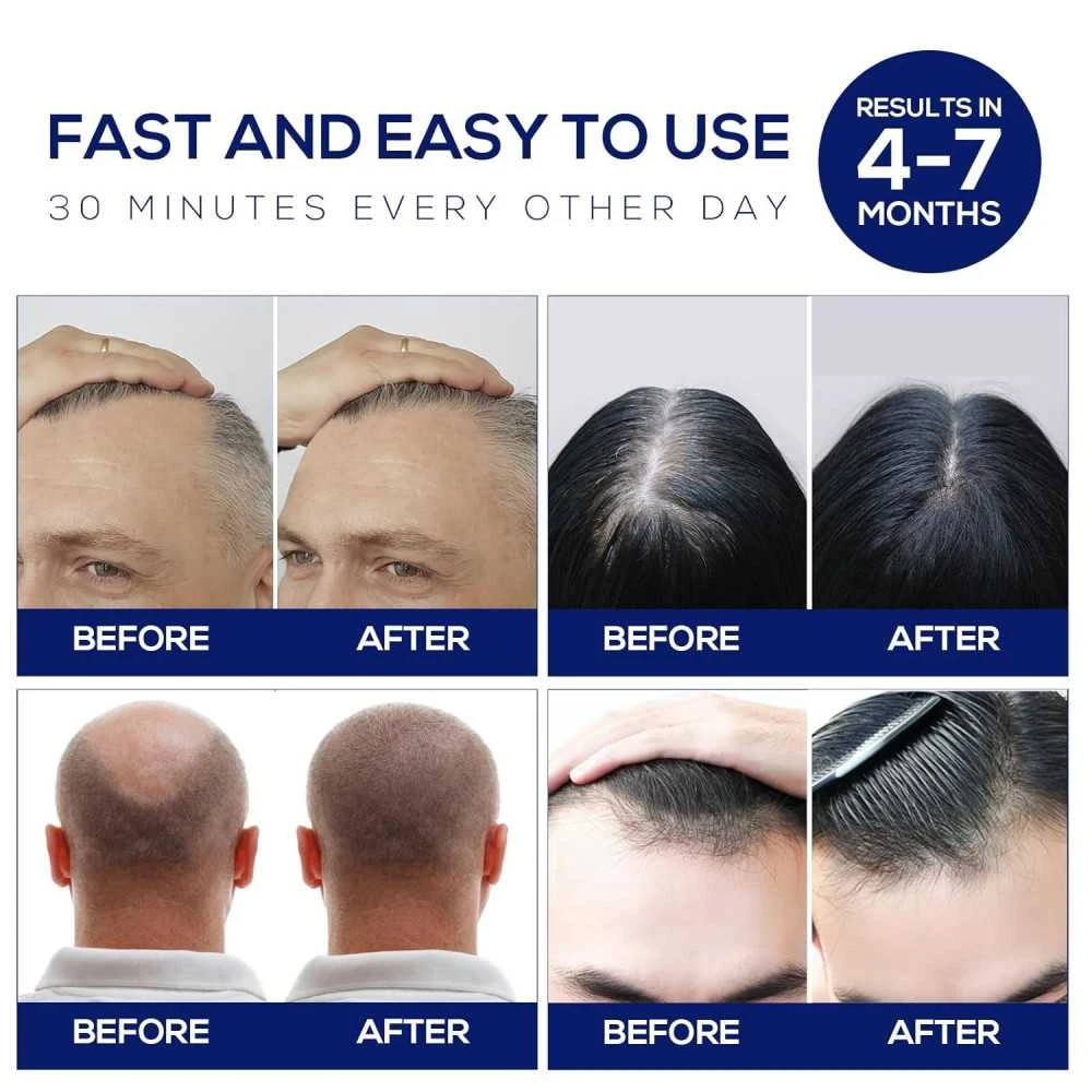 Advanced Laser Hair Growth Cap For Men And Women - Effective Red Light Therapy For Hair Regrowth, Portable And Easy To Use 5 Advanced Laser Hair Growth Cap For Men And Women - Effective Red Light Therapy For Hair Regrowth, Portable And Easy To Use - Image 5