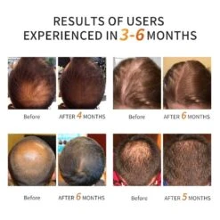 FDA-Cleared Laser Cap For Hair Growth, Treats Hair Loss With Low-Level Laser Therapy, Promotes Regrowth For Men And Women -Electronics Store fda cleared laser cap for hair growth treats hair loss with low level laser therapy promotes regrowth for men and women 2