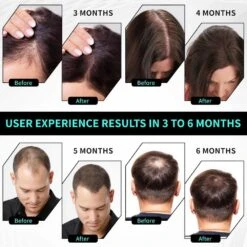 FDA-Cleared Laser Cap For Hair Regrowth, Portable Red Light Therapy Device For Men & Women, Treats Hair Loss And Thinning Hair -Electronics Store fda cleared laser cap for hair regrowth portable red light therapy device for men women treats hair loss and thinning hair 8