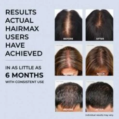 HairMax RegrowMD Laser Hair Growth Cap - FDA Cleared, 30-Min Treatment -Electronics Store laser hair growth products fda cleared by hairmax laser hair growth cap model regrowmd hair loss treatment for men and 6